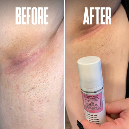 Smoora Ingrown Hair & Razor Bump Stopper Roll-On